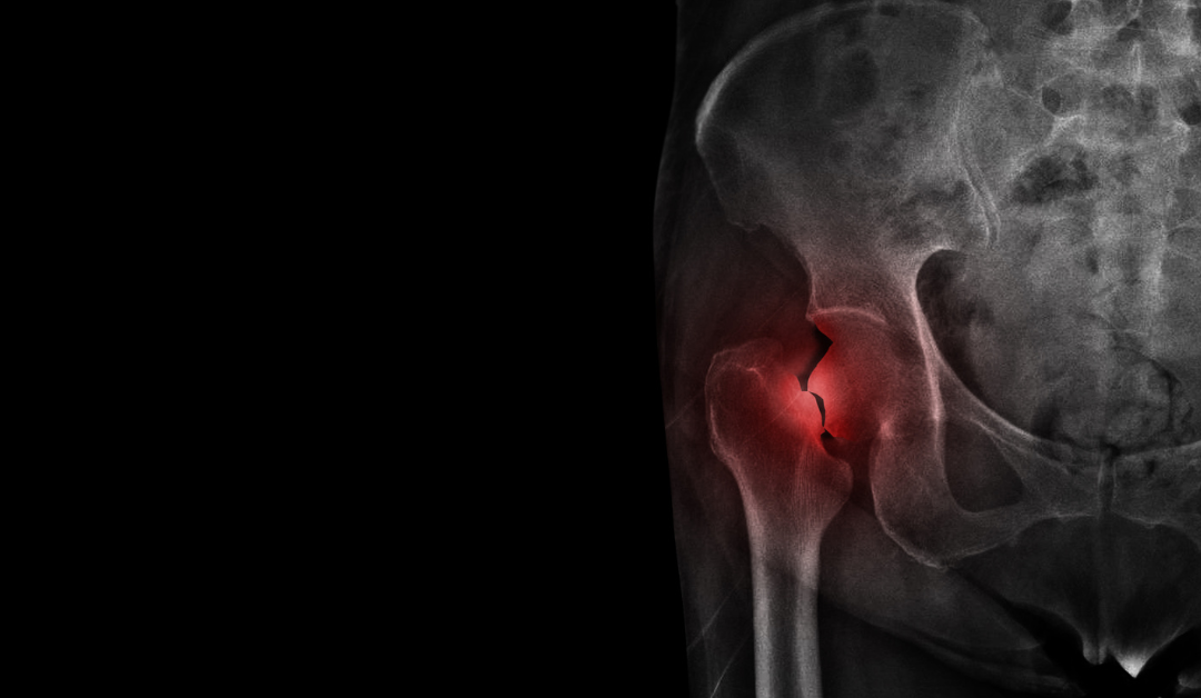 Research Reveals Increased Hip Fracture Risk in Rheumatoid Arthritis