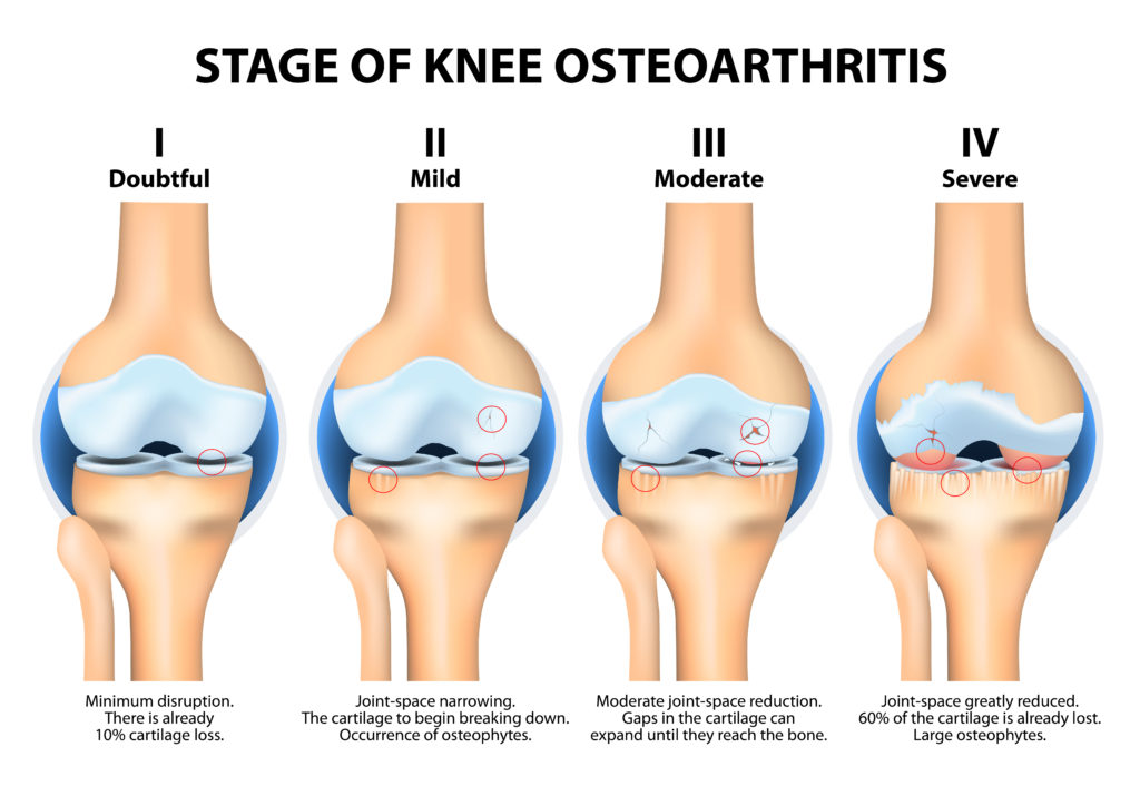 degenerative-stages-of-knee-osteoarthritis-arthritis-research-canada